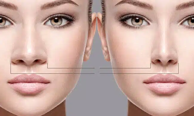 rhinoplasty-in-iran-1