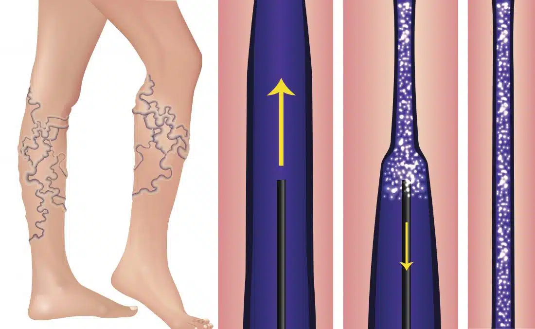 sclerotherapy