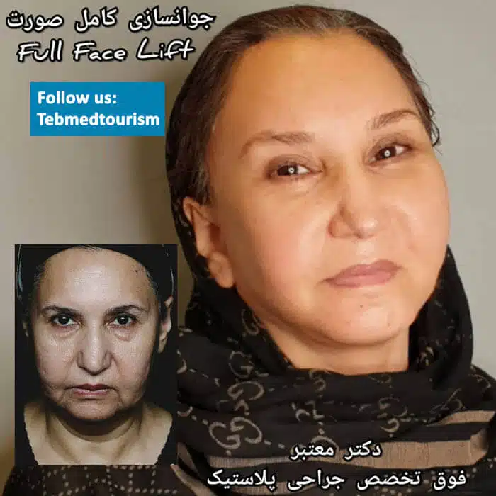 %d8%b4%d8%af-%d8%a7%d9%84%d9%88%d8%ac%d9%87-%d9%81%d9%8a-%d8%a7%d9%8a%d8%b1%d8%a7%d9%86