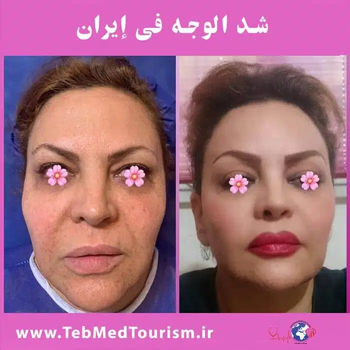 %d8%b4%d8%af-%d8%a7%d9%84%d9%88%d8%ac%d9%87222