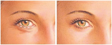 procedure2