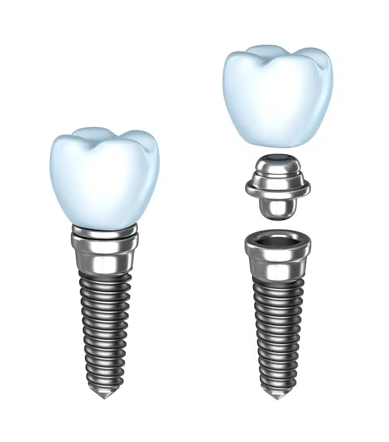 tooth-implant-assembled-and-disassembled-isolated-on-white