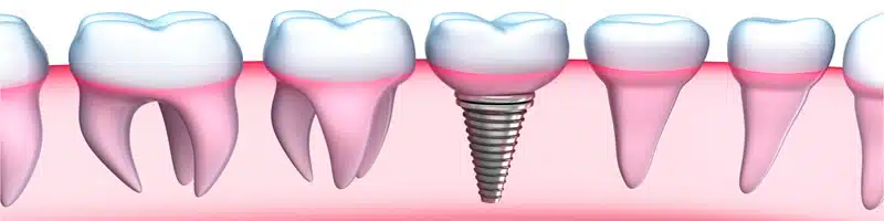 dental-implant-2