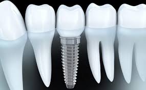 dental3