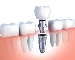dental4