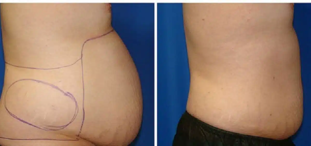 laser-lipolysis-1200x565-2