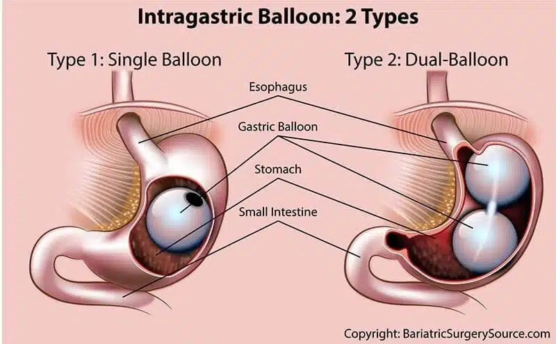 gastric-balloon-procedure-645w