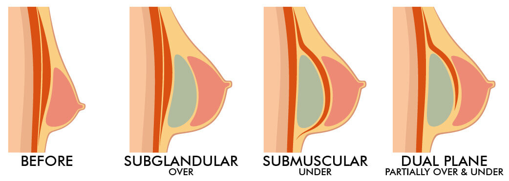 breast-enlargement-images-headers_surgery-1-2