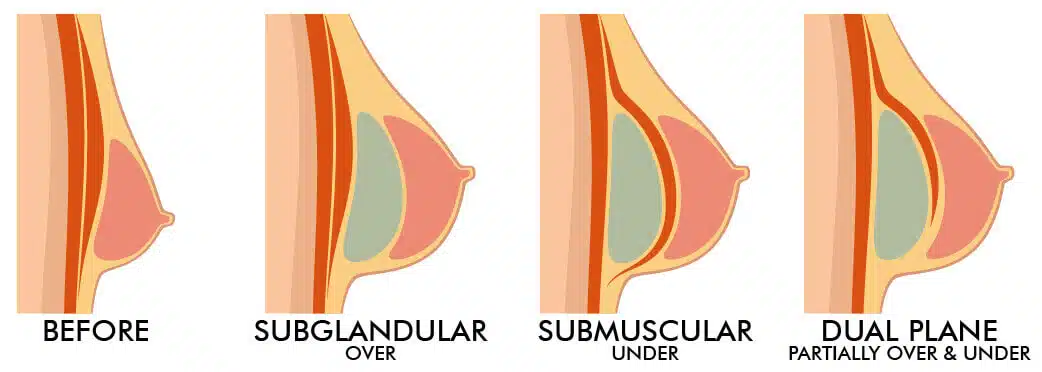صور تكبير الثدي – جراحة