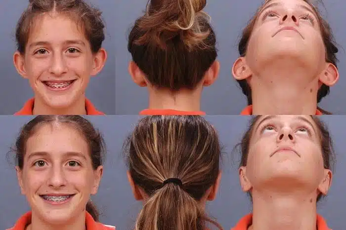 ear-surgery-otoplasty-1322