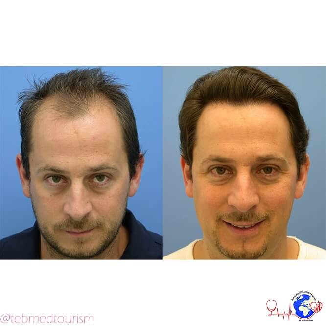 hair-transplant-ba-2