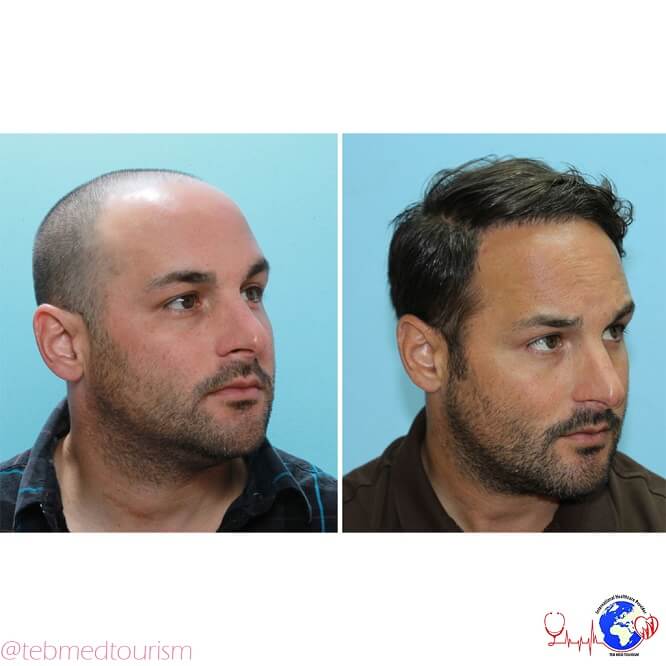 hair-transplant-ba2-2