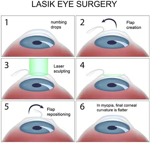 lasik2-2