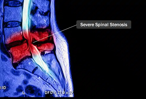 493ss_science_source_rm_spinal_stenosis_mri