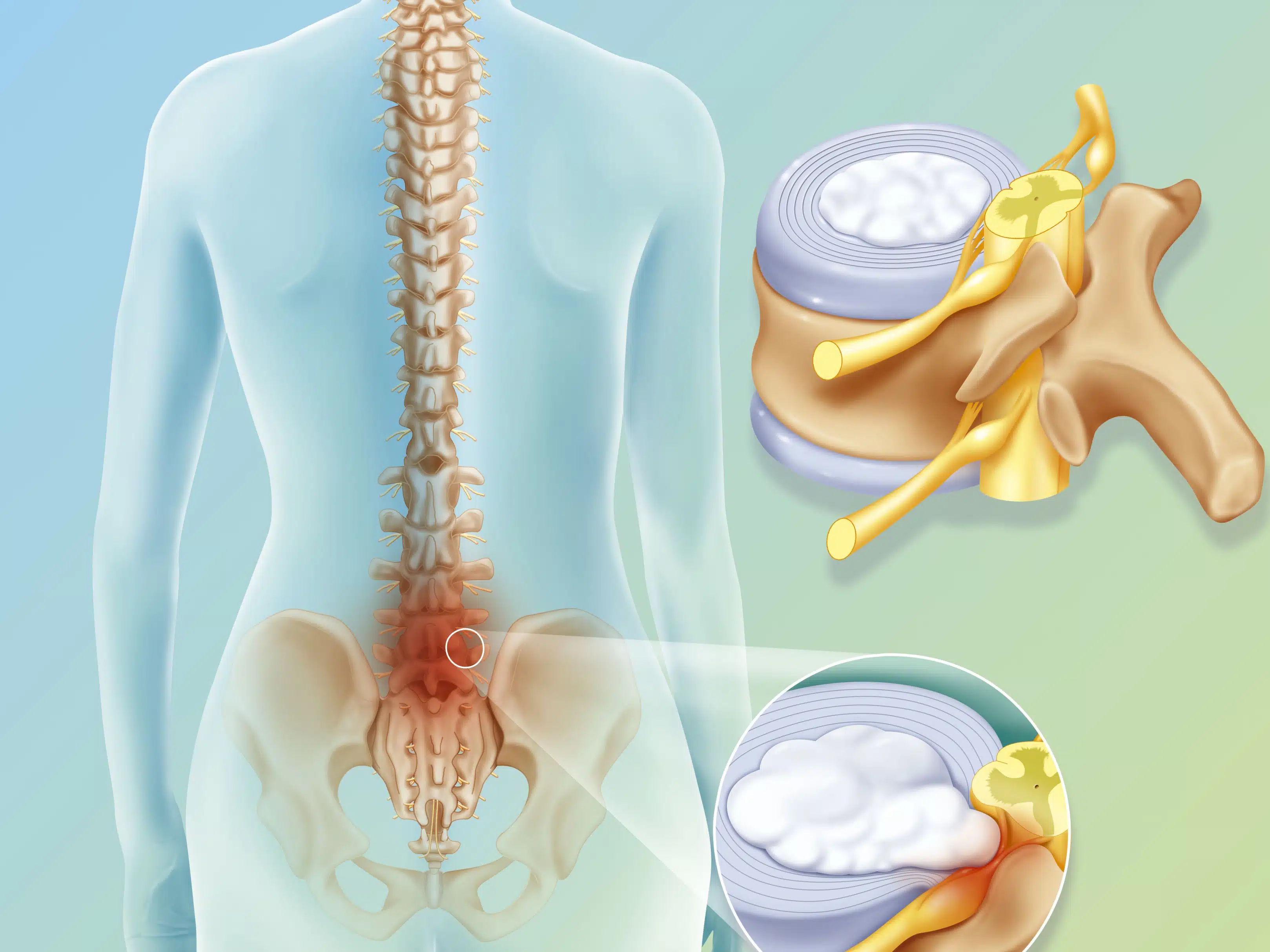 ما هي مخاطر جراحة استئصال القرص