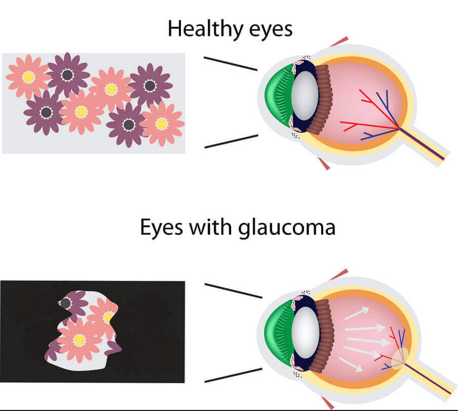 glaucomahrwrwuw