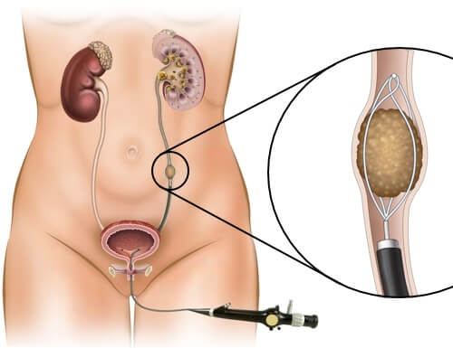 ureteroscopy-1