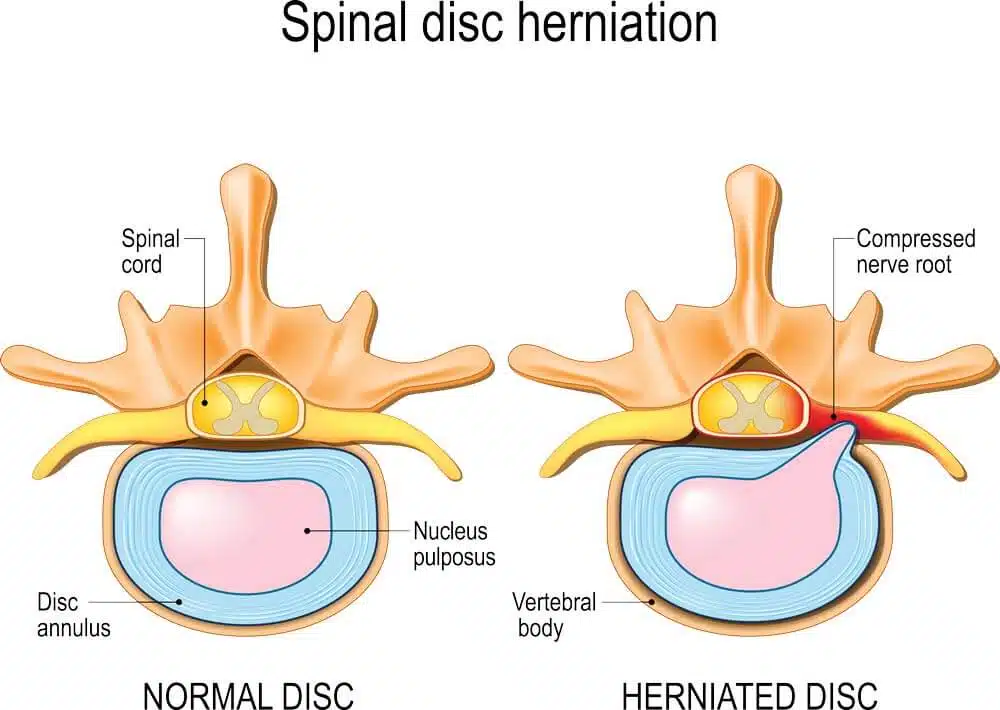 disc-herniation-treatment