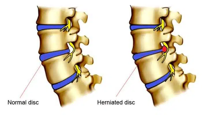 herniated-disc-700x400