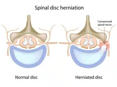 herniated-disc_1200x893-400x298