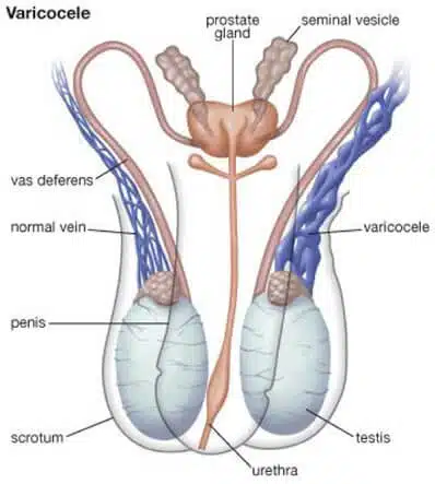 varicocele-repair2-2