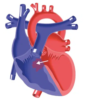 ventricular-septal-defect_edited-2