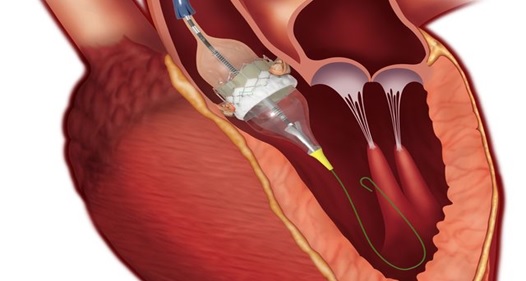 aortic-2