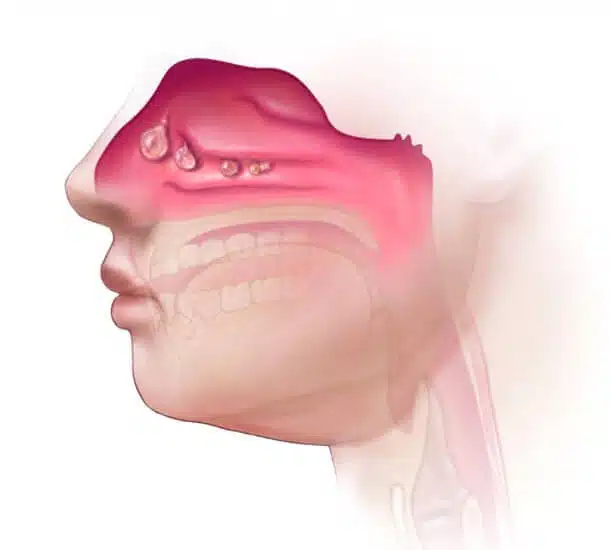 جراحة الجيوب الأنفية بالمنظار