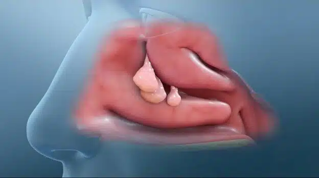 استئصال السلائل الأنفية