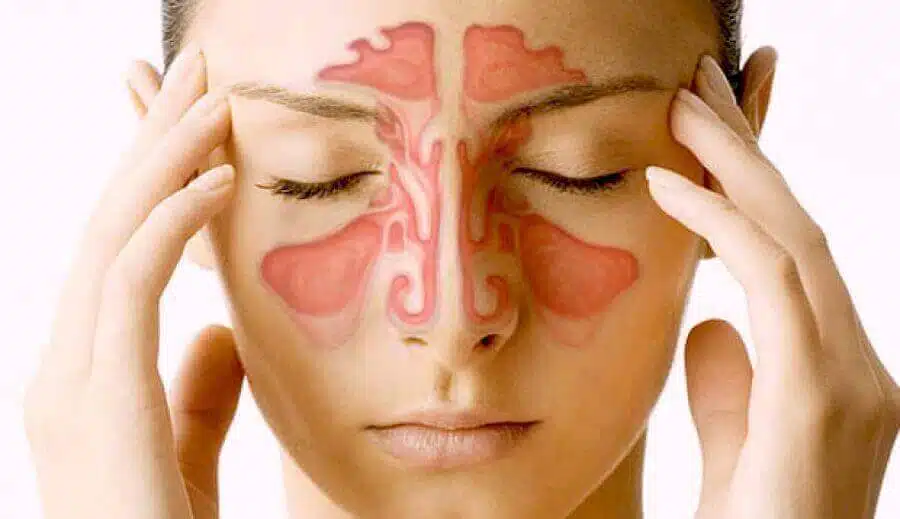 sinusitis