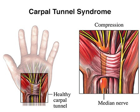 carpal-tunnel-syndrome-4502-2