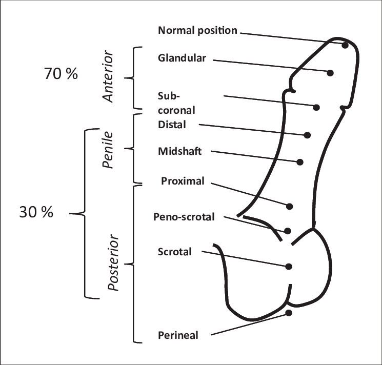 clinical-classification-of-the-severity-of-hypospadias-hypospadias-severity-is-2