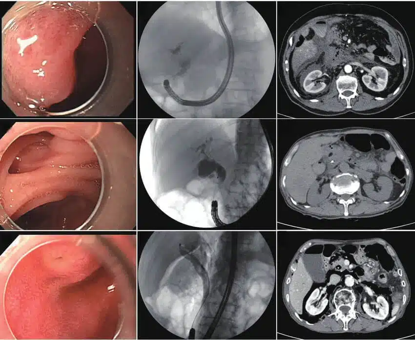 endoscopic-retrograde-cholangiopancreatography-findings-of-endoscopic-view-and-2