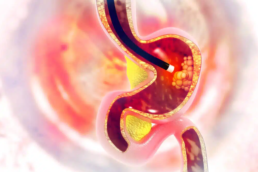 Endoscopy With Small Bowel Biopsy