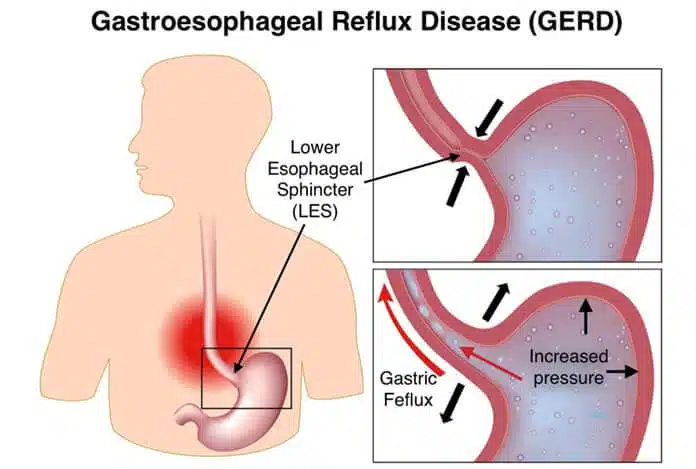 gastroesophageal-reflux-disease-gerd-and-its-most-common-drug-list-2