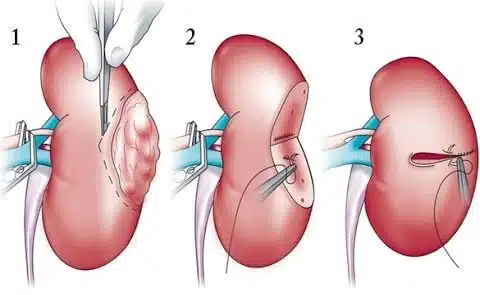 ماذا يحدث بعد جراحة استئصال الكلية