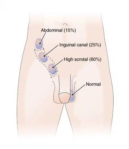 مابعد جراحة تثبيت الخصية المعلقة أو النطاطة ؟