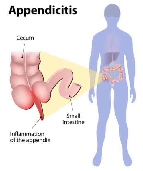 appendicitis-e1484342760890-2
