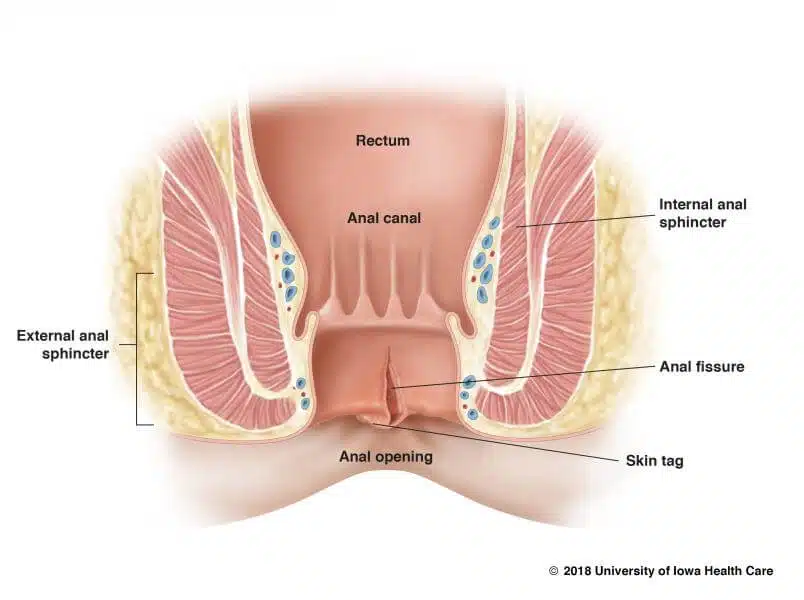 figure1_anal_fissure-final-2