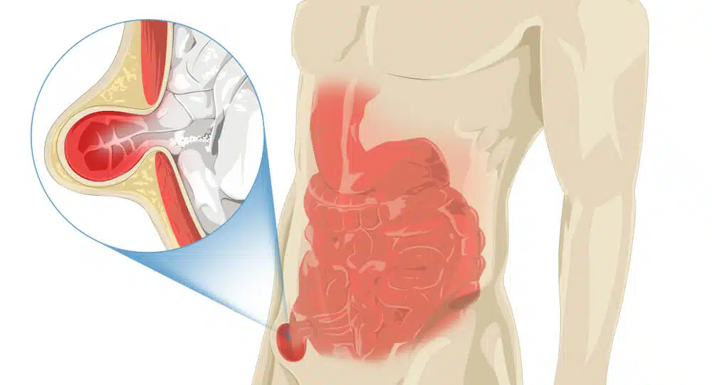illustration-stomach-pain-in-inguinal-2