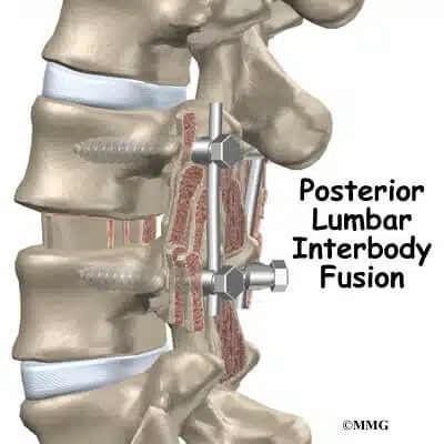 lumbar_plif_intro01-2