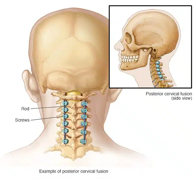 mcdc7_cervical_posterior_fusion-8col-2