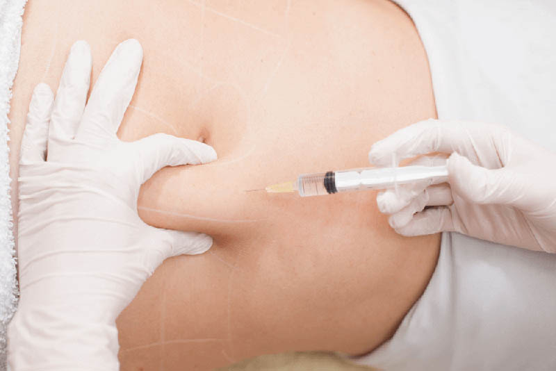 mesotherapy5