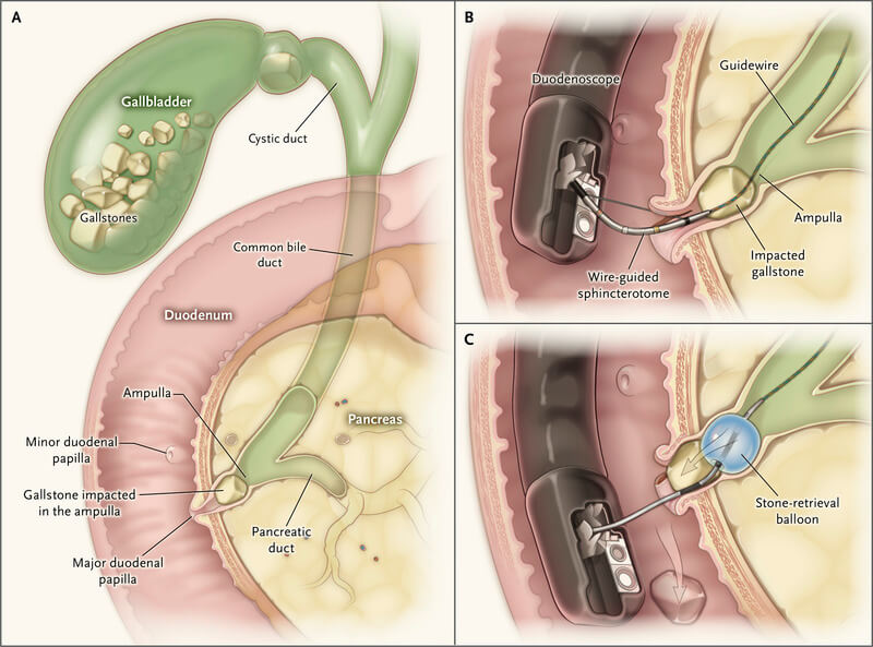 nejmct1208450_f1-jpeg-2