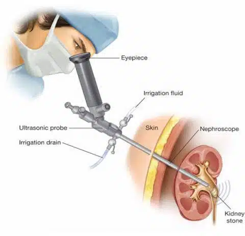 percutaneous-nephrolithotomy-2-2