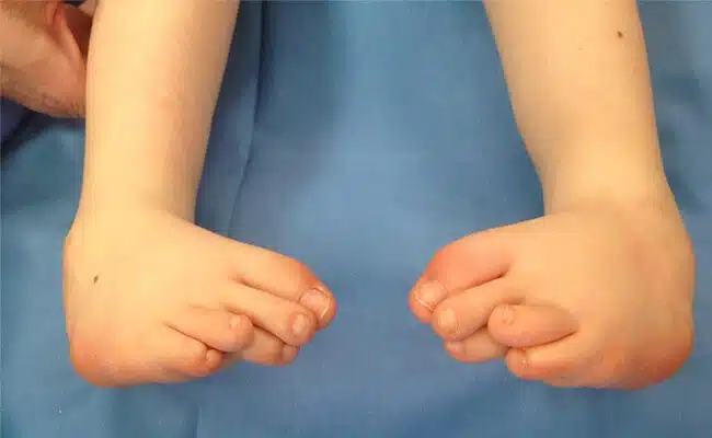 علاج اعوجاج القدم (القدم الحنفاء)