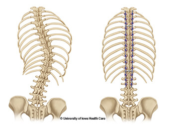 posterior-spinal-fusion-before-and-after-skeletal-illustration-2