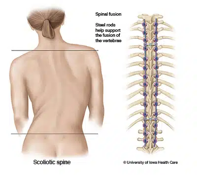 scoliotic-spine-steel-rods-2