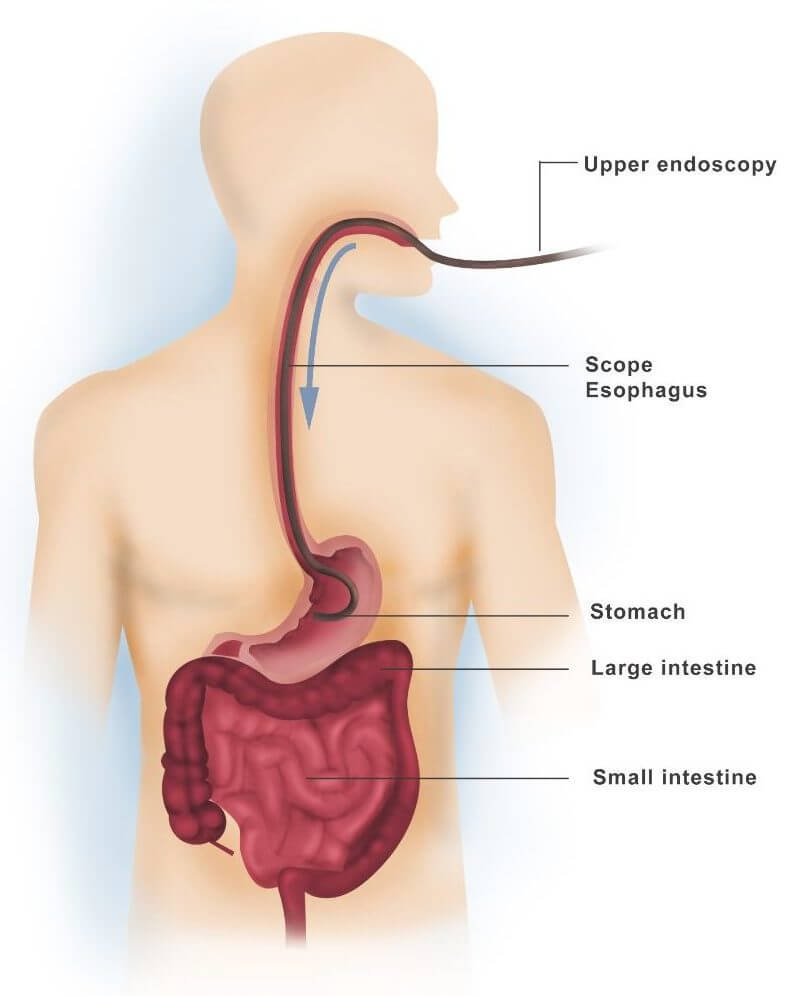 upper-gi-endoscopy-v2-1-e1580221712977-jpeg-2