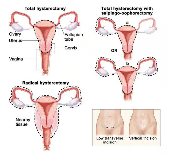 hysterectomy-3-1